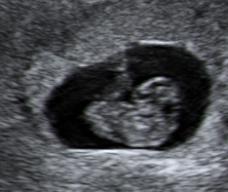 怀孕59天胎儿图