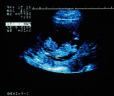 怀孕72天胎儿图