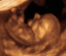 怀孕77天胎儿图