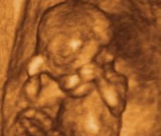 怀孕79天胎儿图