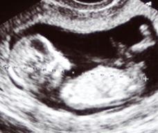 怀孕90天胎儿图