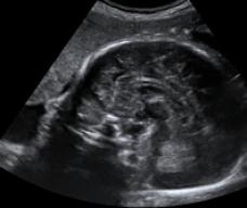 怀孕144天胎儿图