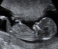 怀孕97天胎儿图