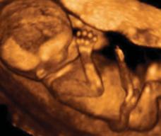 怀孕101天胎儿图