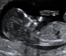 怀孕103天胎儿图