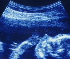 怀孕121天胎儿图